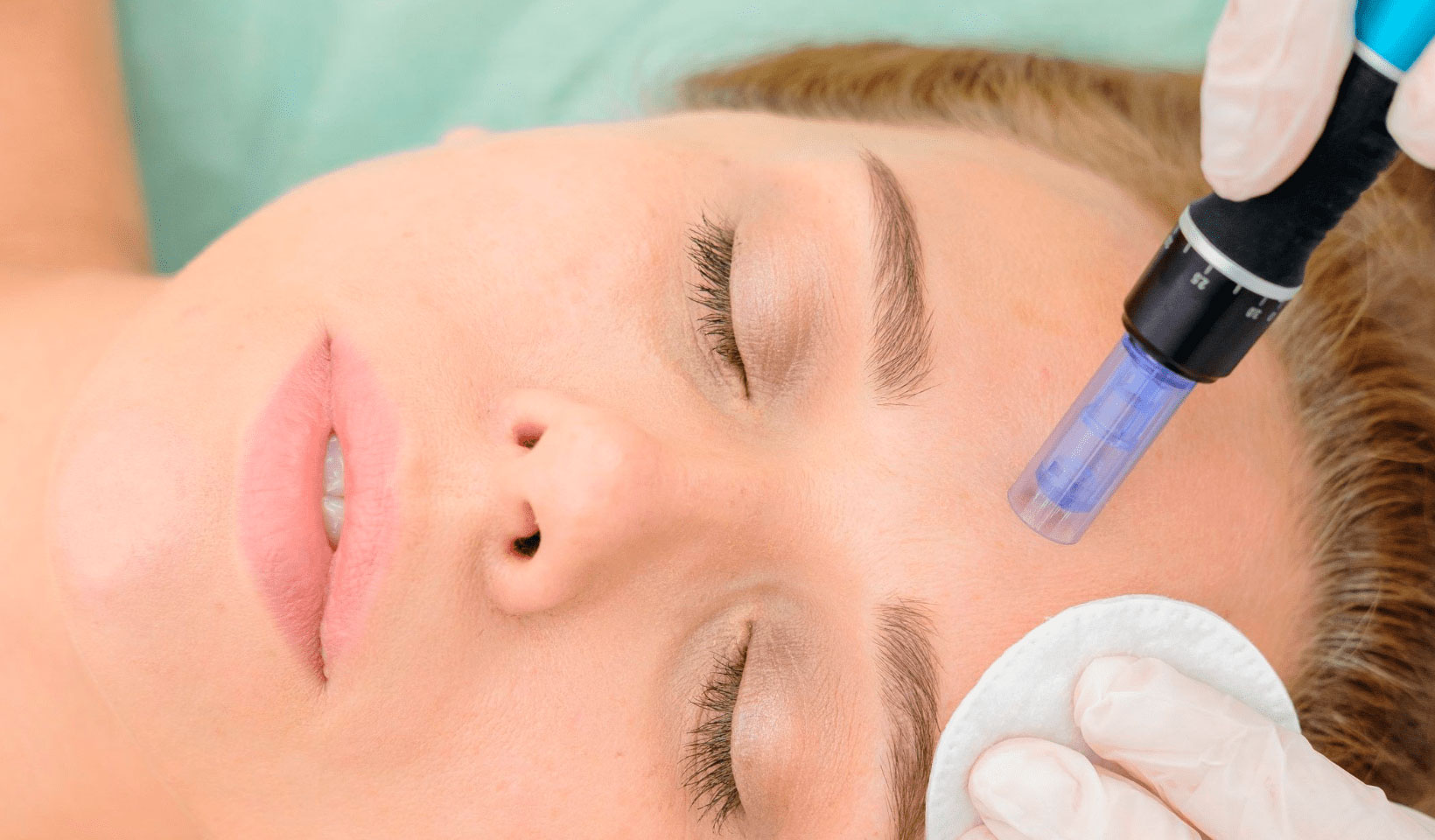 Microneedling-min