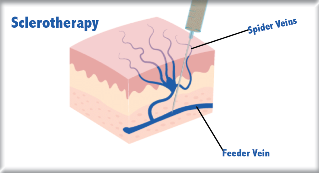 Sclerotherapy-pfms