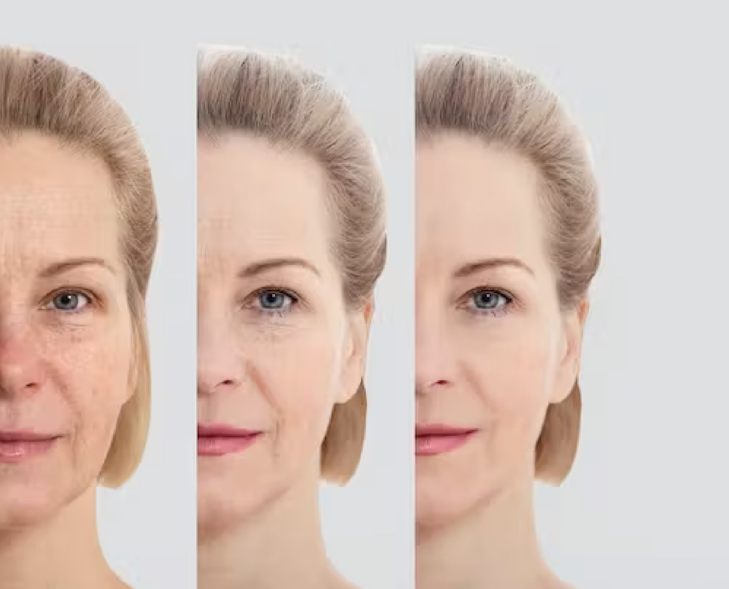 Ozempic Face - Rebuild Collagen